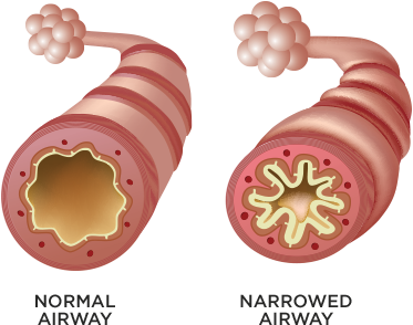 Illustration of a normal airway compared to a narrowed airway